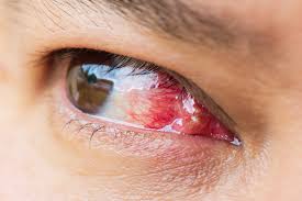Pterygium Surgery