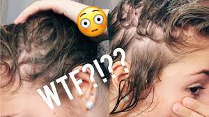 You'll need to use effective contraception while you're taking it and for a month tell your doctor straight away if you notice anything like this. Hair Loss On Accutane Month 1 Update Youtube