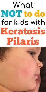 Image result for Keratosis pilaris