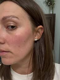 Acne skincare products for chin and cheek breakouts