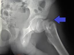 Image result for Fracture XRay