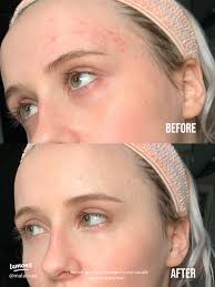 51 top Green Concealer for Redness ideas in 2025