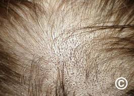 Image result for white scabs on the head in children