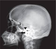 Image result for Skull XRay