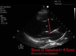 Accuracy And Potential Of Ctca-Guided Ica
