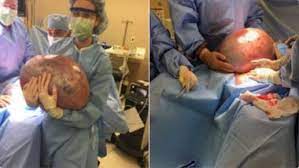 Talk to our chatbot to narrow down your search. 50 Pound Ovarian Cyst Removed From Alabama Woman Who Was Asked To Lose Weight See Shocking Images Latestly
