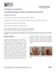 Souvent les lésions sont asymptomatiques et une abstention thérapeutique est tout à fait licite. Pdf Une Melanonychie Suspecte Revelant Un Syndrome De Laugier Hunziker