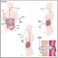 Nursing diagnoses • impaired skin integrity related to cutaneous manifestations. Nursing Diagnosis For Gastrostomy Nursing Care Plan