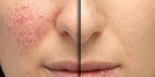 Massaging regularly your affected skin area is another simple way on how to get rid of spider veins. Red Thread Vein Treatments For Face And Legs At Cheshire Lasers Clinic