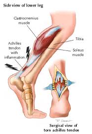 Learn more about the rehab, recovery time, & exercise protocols for ruptured achilles/torn achilles or other achilles tendon surgery injury repairs. Achilles Rupture Physiopedia