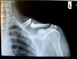 X Rays Of Broken Bones 20090323 Brokenclav Lance Armstrongs Broken Collarbone Broken Bone Medical Information Medical