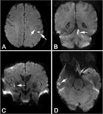 Read about brain aneurysm (cerebral aneurysm) symptoms, signs, surgery, causes, survival rates, recovery, treatment, coiling, prognosis, survival rate, statistics, rupture, and more. Early Diffusion Weighted Mri Lesions After Treatment Of Unruptured Intracranial Aneurysms A Prospective Study In Journal Of Neurosurgery Volume 126 Issue 4 2017