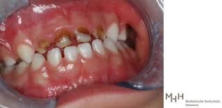 Karies Und Kreidezahne Schlechte Zahne Bei Kindern Nehmen Zu Zwp Online Das Nachrichtenportal Fur Die Dentalbranche