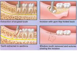 Wisdom Teeth Removal News Tooth Extraction Aftercare Wisdom Tooth Extraction Wisdom Teeth