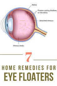 How You Can Get Rid Of Eye Floaters Eye Floaters Cure Healthy Eyes Dry Eyes Causes