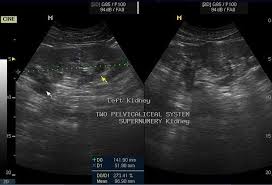Sumer S Radiology Blog Supernumerary Kidney Ultrasound Ultrasound Kidney Radiology