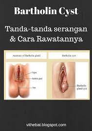 Akan tetapi berkenaan dengan kapan terjadinya, (hari, tanggal, bulan dan. Badan Sihat Hati Ceria Tanda Tanda Bartholin Cyst Dan Cara Rawatannya
