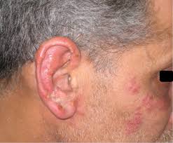 Herpes simplex type 2 is the most frequent cause of neonatal herpes, a very uncommon, but dangerous infection in newborns. Disseminated Primary Hsv 2 Infection Of The Face