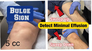 Image result for Knee Bulge Sign