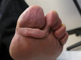 Most often a black spot that looks like you dropped something on your toe is an old hemorrhage from trauma. An Asymptomatic Fleshy Tumor On The Base Of The Toe Clinical Advisor