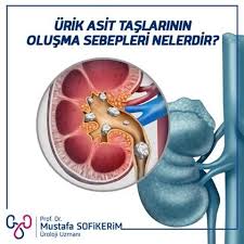 5 Begenme 0 Yorum Instagram Da Prof Dr Mustafa Sofikerim Prof Dr Mustafasofikerim Urik Asit Taslari Genellikle Idrarin Normalden Fazla Asitik Yapida In 2020