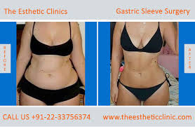 Check out the best gastric sleeve before and after pictures to get some inspiration. Gastric Sleeve Surgery In Mumbai India The Esthetic Clinics