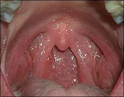 The oral cavity proper which is the region medial to the teeth. Anterior And Posterior Pharyngeal Pillars The Intraoral And Extraoral Exam Continuing Education Course Dentalcare Com
