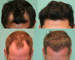 When i moved to the istudio salons, my business doubled. Hair Transplant Surgeon Follicular Unit Hair Transplant Hair Loss Walnut Creek Bay Area San Jose San Francisco California
