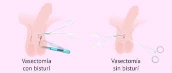 Jun 13, 2019 · el imss informó que las jornadas de vasectomías sin bisturí gratuitas se llevan a cabo durante todo el año tanto para derechohabientes como para población en general. Imss Lanza Campana De Vasectomia Sin Bisturi Ciencia