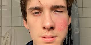 Strand fick flera frakturer i ansiktet av bandyboll