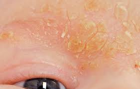Image result for yellow scabs on the face in children