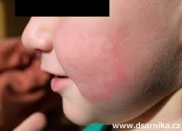 Image result for vyrážka u dětí