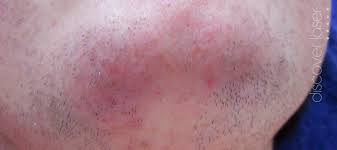 However, there is hope and help through both our laser hair removal for pcos symptoms and skin rejuvenation treatments. Polycystic Ovarian Syndrome Medical And Dermatology Skin Clinic Burnley Lancashire