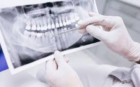 Dental X-Rays: Purpose, Procedure, and Risks - Best Dental Clinic Toronto