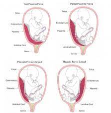 The Women S Center At Southwest Health Placenta Previa