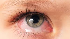 Image result for Vernal Conjunctivitis
