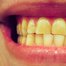 After cleaning procedure ask them for brushing technique to brush properly and maintain oral hygiene from there on till the treatment. Yellow Teeth What Causes Them Do You Need To Worry About It Electric Teeth