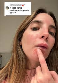 Colazione da Anna: Tecniche di Laser CO2