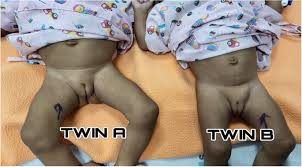 Image result for Inguinal hernia child