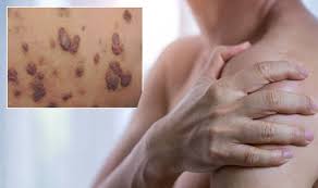 The sooner a skin cancer is identified and treated, the better your chance of avoiding surgery or, in the case of a serious melanoma or other skin cancer, potential disfigurement or even death. Skin Cancer Symptoms Purple Patches On The Skin Could Be A Sign Of The Deadly Disease Daily Star Post