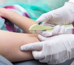 Image result for Implanon