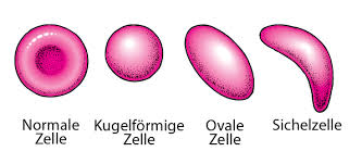 Sickle cell anemia) ist eine erbliche erkrankung der roten blutkörperchen (erythrozyten). Sichelzellanamie Bluterkrankungen Msd Manual Ausgabe Fur Patienten