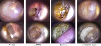 Image result for Myringosclerosis