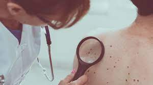 Look for signs of cancer beyond the skin. Melanoma Skin Cancer May Be Detected Early With Blood Test Study Finds Allure