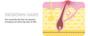 10 ﻿ use these diy mixes to exfoliate, prevent, and soothe any irritations. Help Can I Exfoliate Away Ingrown Hair Viabuff