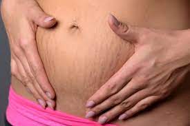 What Postpartum Belly Binding Can And Can T Do For Your Stomach Care Com