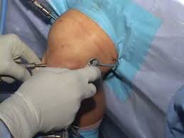In 2016 i had acl surgery. Acl Reconstruction Surgical Technique Youtube