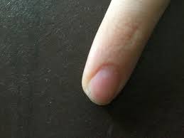 Kleine Schwarze Striche An Den Fingernageln Fingernagel