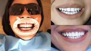 Tooth extraction costs from $50 up to $1,100 | authority … How I Fixed My Teeth Without Veneers Part 2 Youtube