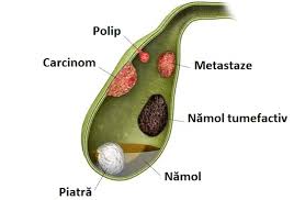 Este uneori însoțită de febră sau vărsături. Polipi Vezica Biliara Simptome Cauze Factori De Risc Tratament Lataifas
